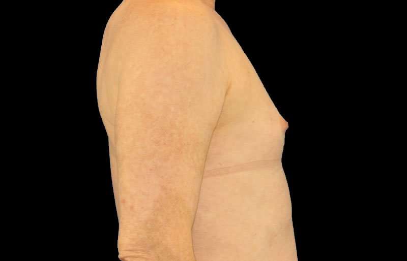 Male To Female Breast Before & After Patient #3911