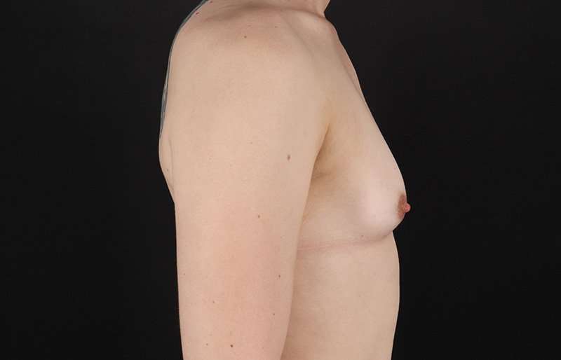 Male To Female Breast Before & After Patient #3933