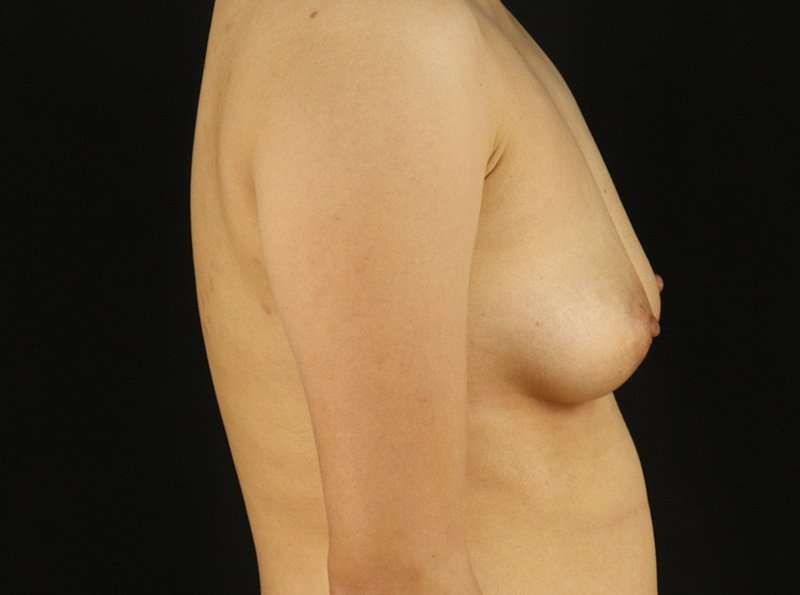 Female To Male Breast Before & After Patient #3944