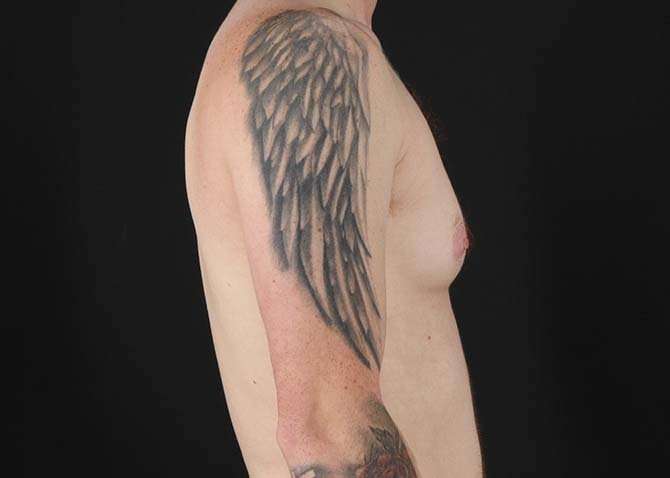 Female To Male Breast Before & After Patient #3955