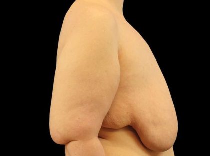 Female To Male Breast Before & After Patient #3966