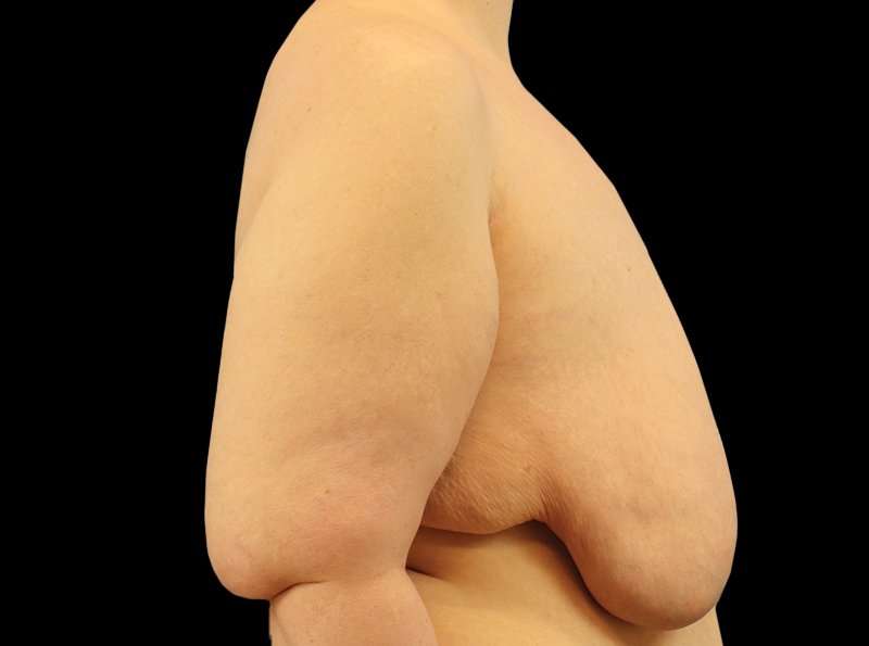 Female To Male Breast Before & After Patient #3966