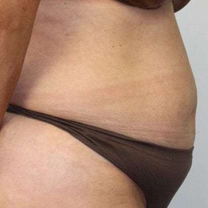 Abdominoplasty (Tummy Tuck) Before & After Patient #897