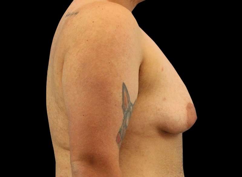 Female To Male Breast Before & After Patient #3977