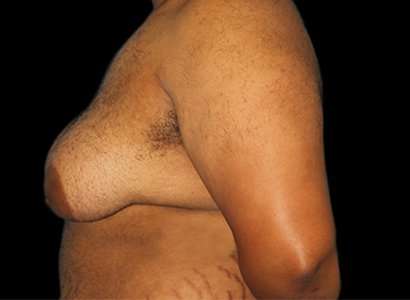 Female To Male Breast Before & After Patient #3984