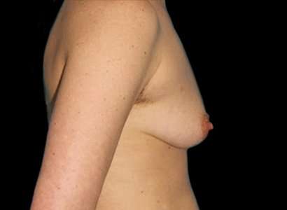 Female To Male Breast Before & After Patient #3991