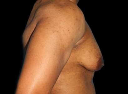 Female To Male Breast Before & After Patient #3998
