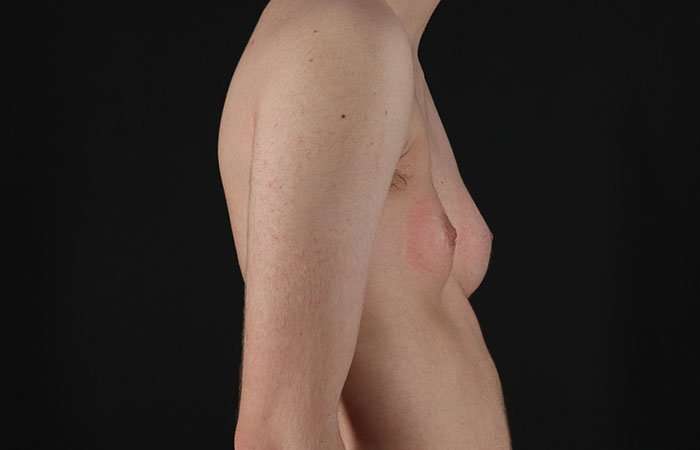 Female To Male Breast Before & After Patient #4031