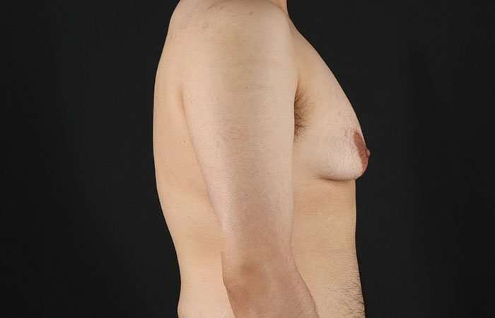 Female To Male Breast Before & After Patient #4042