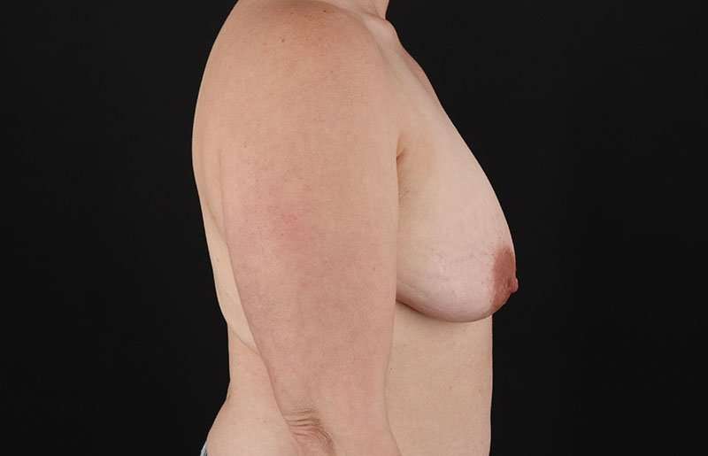 Female To Male Breast Before & After Patient #4064