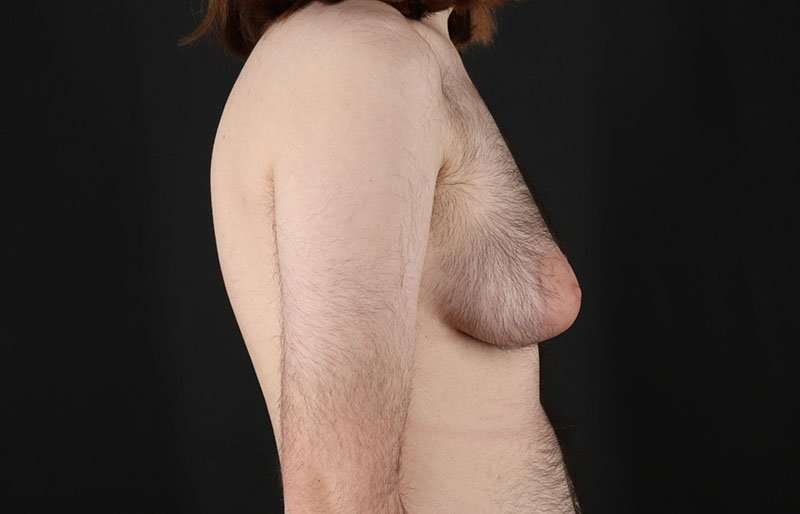 Female To Male Breast Before & After Patient #4075