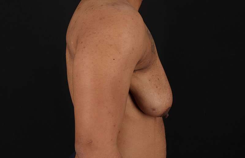 Female To Male Breast Before & After Patient #4086