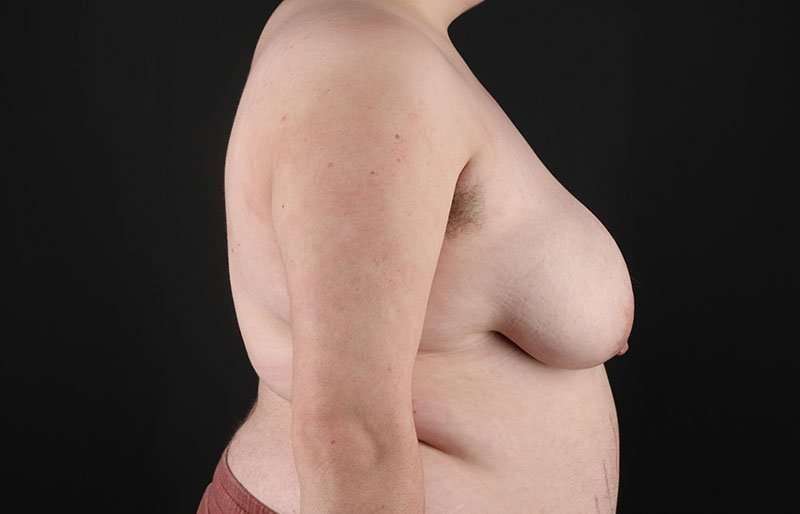 Female To Male Breast Before & After Patient #4097