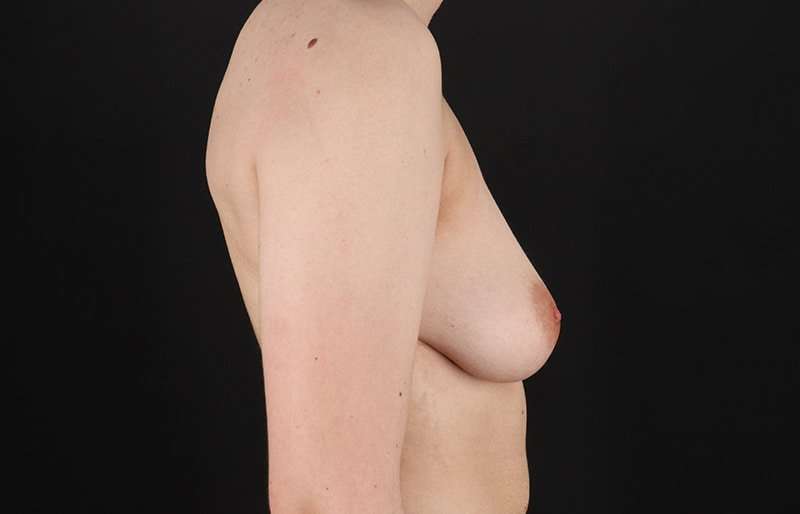 Female To Male Breast Before & After Patient #4108
