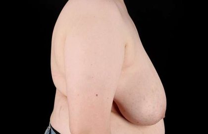 Female To Male Breast Before & After Patient #4130
