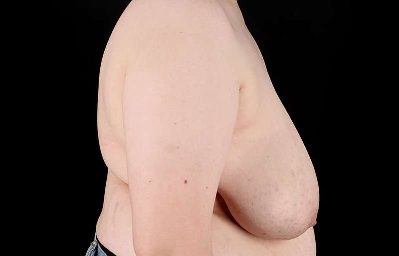 Female To Male Breast Before & After Patient #4130