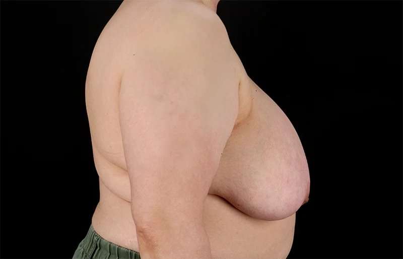 Female To Male Breast Before & After Patient #4141