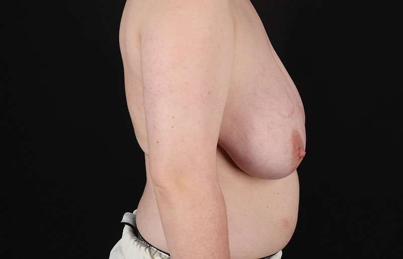 Female To Male Breast Before & After Patient #4174
