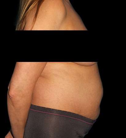 Abdominoplasty (Tummy Tuck) Before & After Patient #590