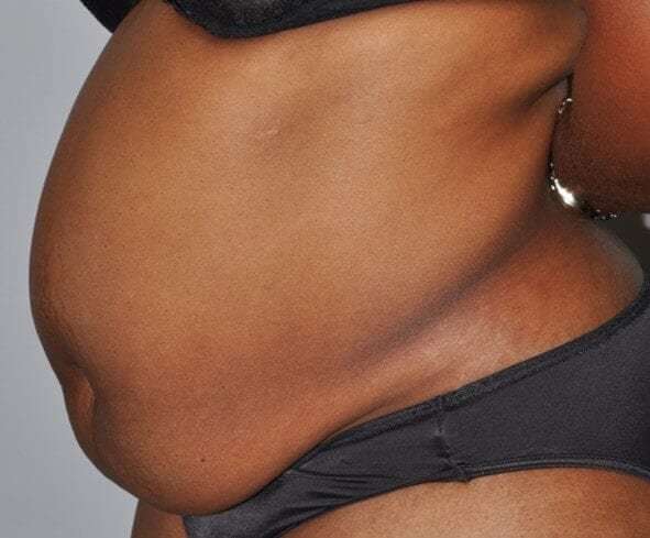 Abdominoplasty (Tummy Tuck) Before & After Patient #913