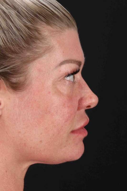 Fat Grafting To The Face Before & After Patient #4232