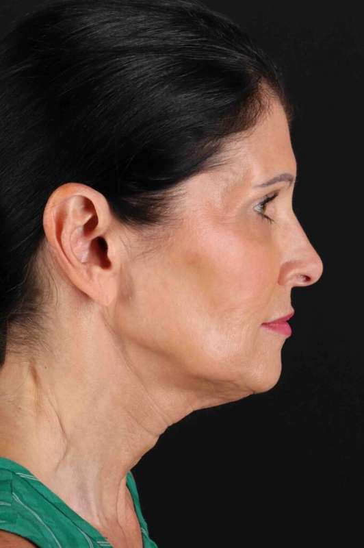 Fat Grafting To The Face Before & After Patient #4254