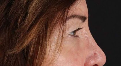 Blepharoplasty (Eyelid Surgery) Before & After Patient #4316