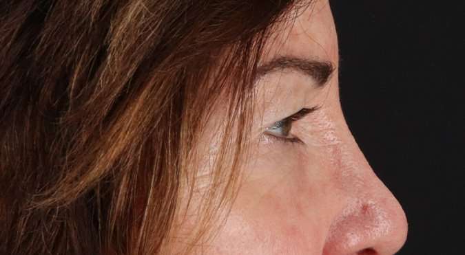 Blepharoplasty (Eyelid Surgery) Before & After Patient #4316
