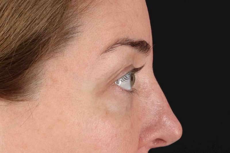 Blepharoplasty (Eyelid Surgery) Before & After Patient #4338