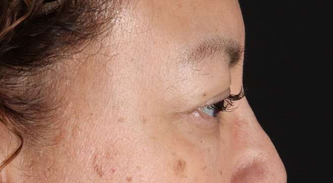 Blepharoplasty (Eyelid Surgery) Before & After Patient #4349