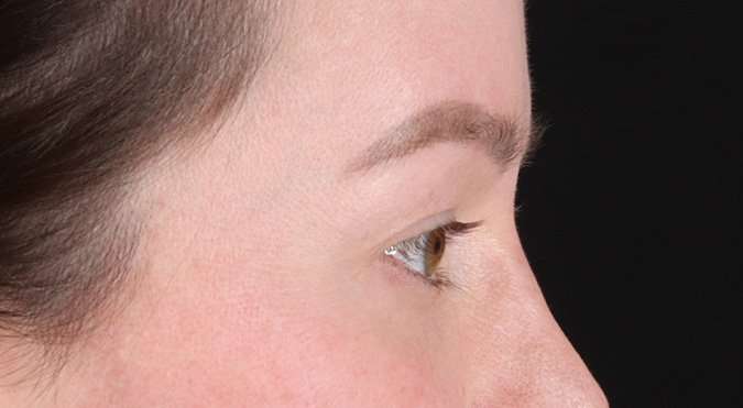 Blepharoplasty (Eyelid Surgery) Before & After Patient #4360