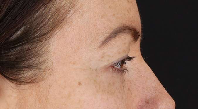 Blepharoplasty (Eyelid Surgery) Before & After Patient #4371
