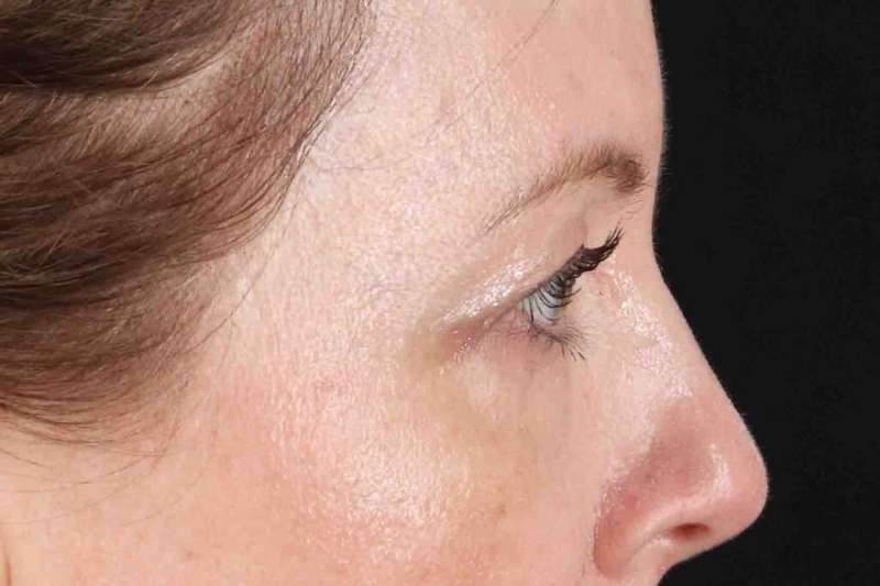Blepharoplasty (Eyelid Surgery) Before & After Patient #4382