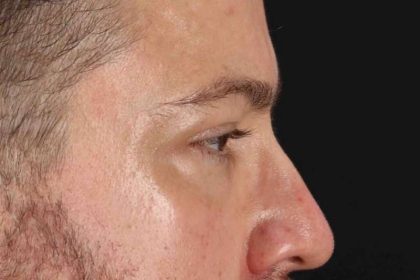 Blepharoplasty (Eyelid Surgery) Before & After Patient #4393