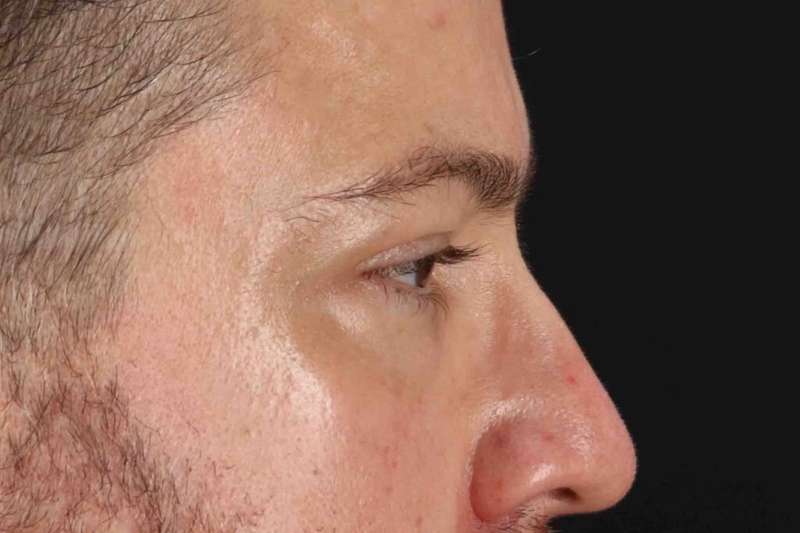 Blepharoplasty (Eyelid Surgery) Before & After Patient #4393