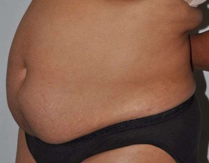 Abdominoplasty (Tummy Tuck) Before & After Patient #928