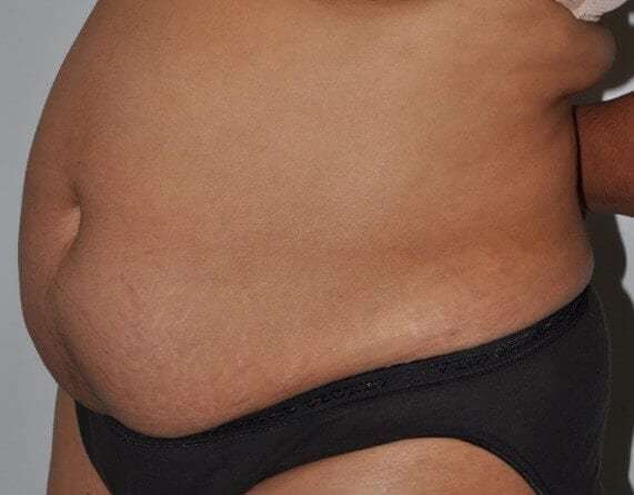 Abdominoplasty (Tummy Tuck) Before & After Patient #928
