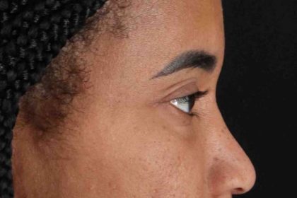Blepharoplasty (Eyelid Surgery) Before & After Patient #4404