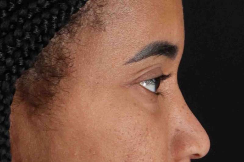 Blepharoplasty (Eyelid Surgery) Before & After Patient #4404