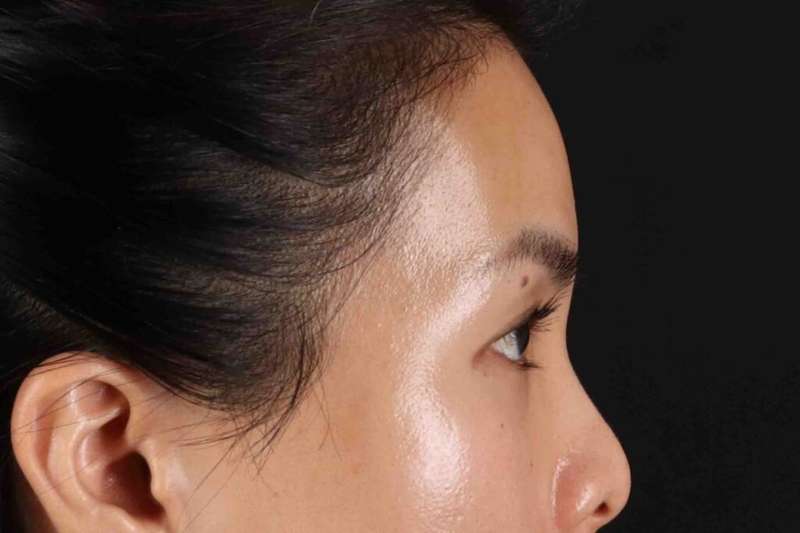 Blepharoplasty (Eyelid Surgery) Before & After Patient #4415