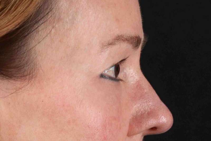 Blepharoplasty (Eyelid Surgery) Before & After Patient #4426