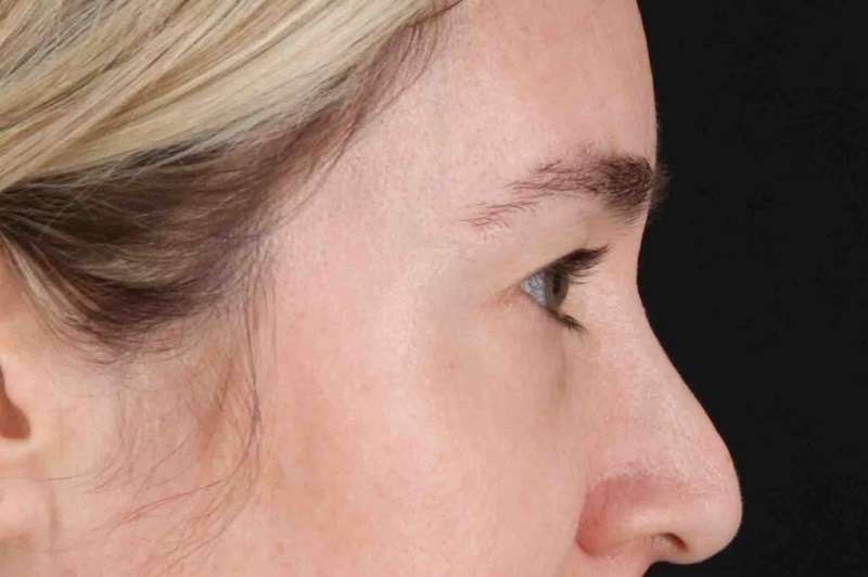 Blepharoplasty (Eyelid Surgery) Before & After Patient #4437