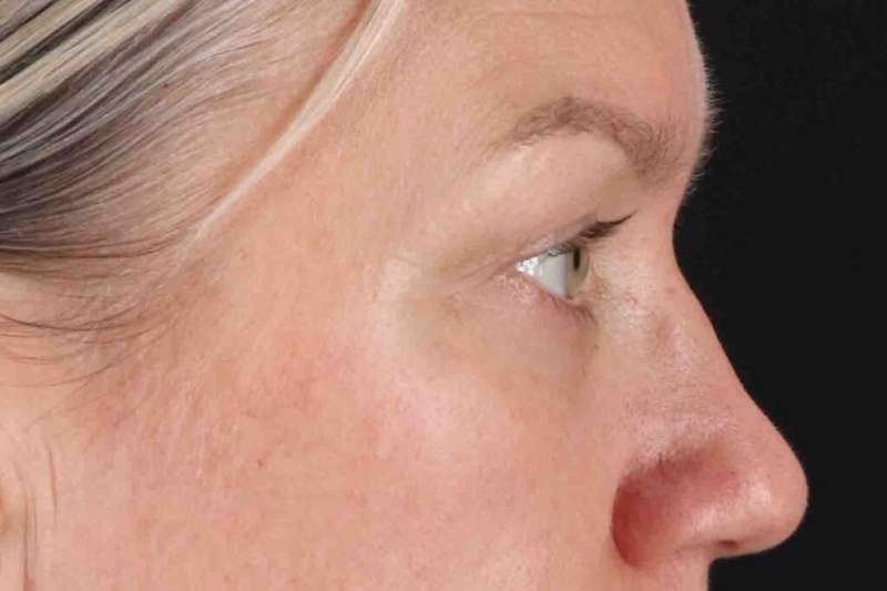Blepharoplasty (Eyelid Surgery) Before & After Patient #4448