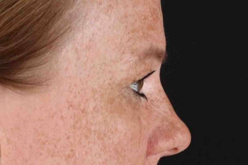 Blepharoplasty (Eyelid Surgery) Before & After Patient #4459