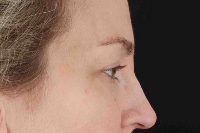 Blepharoplasty (Eyelid Surgery) Before & After Patient #4470