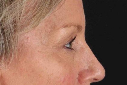 Blepharoplasty (Eyelid Surgery) Before & After Patient #4492
