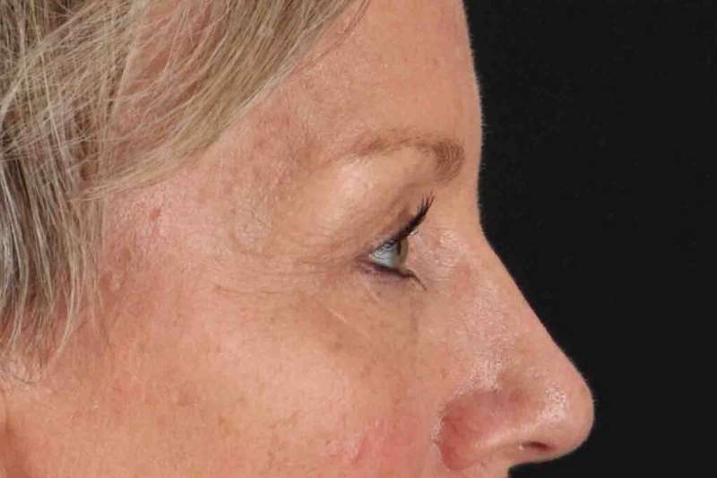 Blepharoplasty (Eyelid Surgery) Before & After Patient #4492