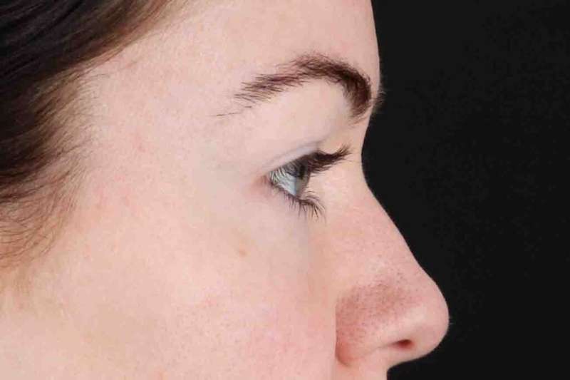 Blepharoplasty (Eyelid Surgery) Before & After Patient #4503