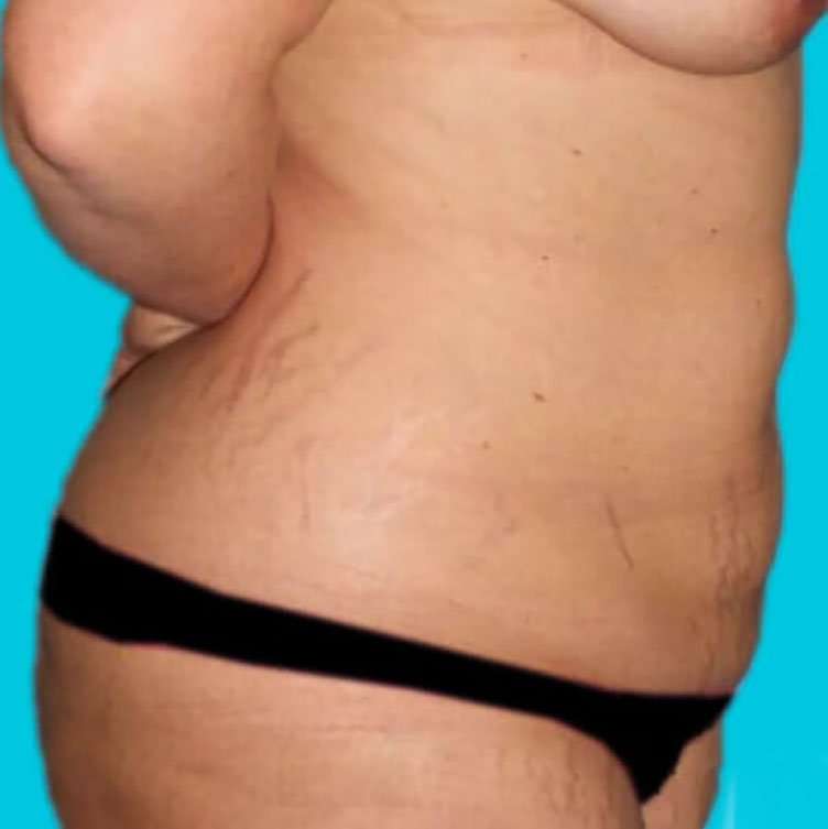 Abdominoplasty (Tummy Tuck) Before & After Patient #936