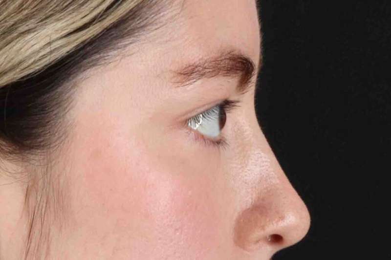 Blepharoplasty (Eyelid Surgery) Before & After Patient #4514